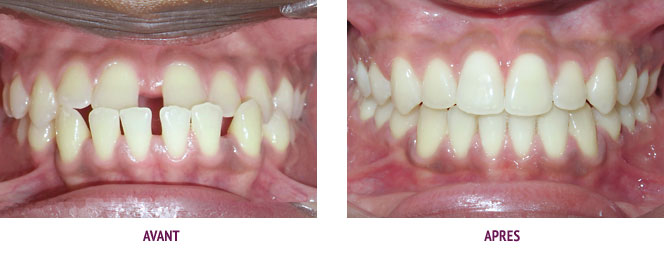 Chirurgie orthodontique - mini-vis 