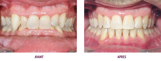 Orthodontie Paris Cas 16 Avancée de la mandibule avec une chirurgie orthognathique