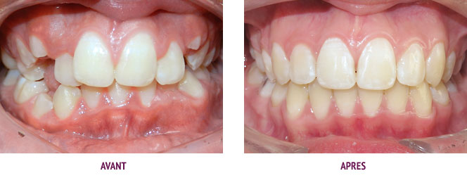 Orthodontie Paris Cas 17 Malocclusion dans les trois sens de l’espace et inclusions dentaires
