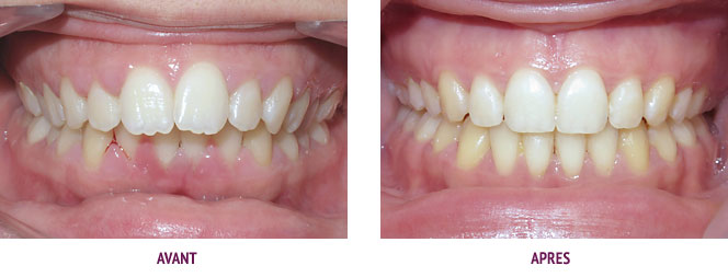 Orthodontie Paris Cas 21 Correction d’un décalage sévère avec des extractions sur un parodonte affaibli