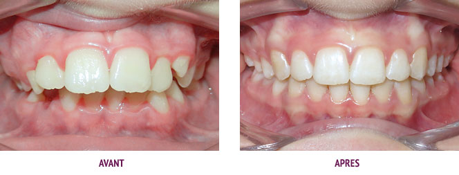 Orthodontie Paris Cas 22 Stimulation de la croissance mandibulaire avec des élastiques