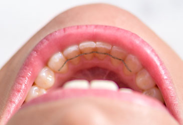 Alignement des dents avec les gouttières transparentes DentoSmile